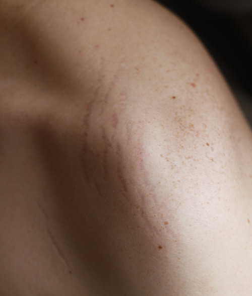 ginocchia:  My boyfriend’s stretch marks, one of the most beautiful things I’ve ever seen.