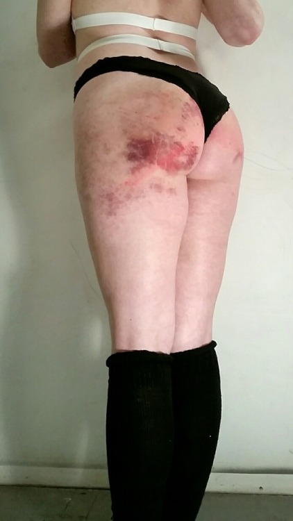 princesssparklecunt: I asked Mister to give me bruises on top of the ones I already had. I sat funn