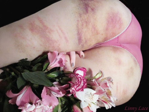 linnylace:Late Valentine’s Day post: this is easily becoming one of my favorite bruise-related photosets. The flowers were picked out specifically with my bruise colors in mind ♡  