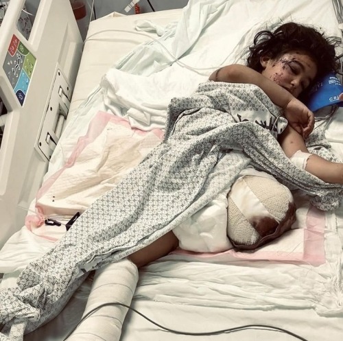 The Little Girl Aseel Musameh, 7 Years Old, Was Injured Following The Bombing Of Her House By Israel.