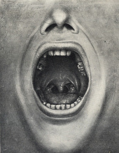 biomedicalephemera:  Pulled teeth and tooth decay, especially of the upper jaw In