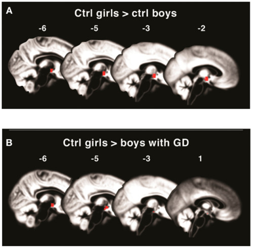 neurosciencestuff:The brain’s reaction to male odor shifts at puberty in children with gender dyspho