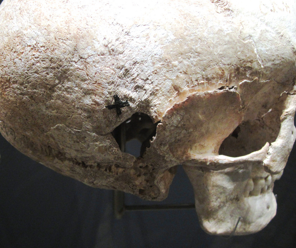 emt-monster:  Healed head injuries from sword blows (meaning they survived the injury)