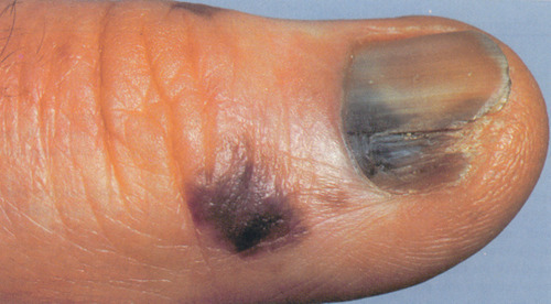 Acral lentiginous melanoma