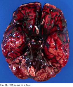 smellslikecadaverine:  Massive Subarachnoid Hemorrhage (SAH) of the basal side of the brain.Fulminant death occurs with 100 mL of blood filling the subarachnoid space. Most of spontaneous SAH (75-80%) are secondary to the breakage of aneurysms located