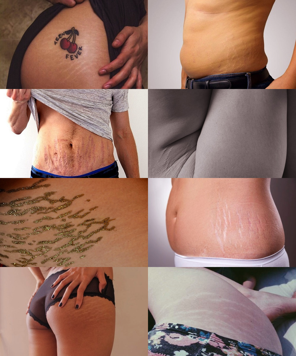 Stretch Mark Tattoos Can They Cover The Marks Effectively