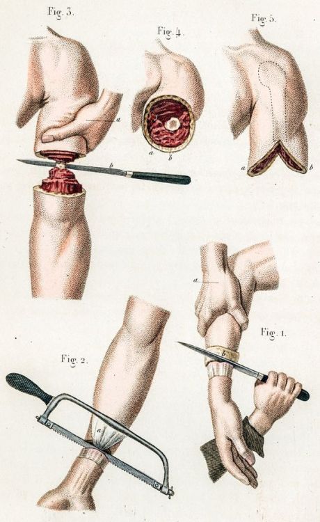 Civil War-era illustration of arm amputation procedure