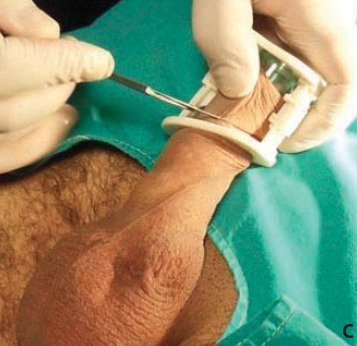 foreskin2cut: circdad: The new snap on clamps get a good result on men and boys of all ages. Love th
