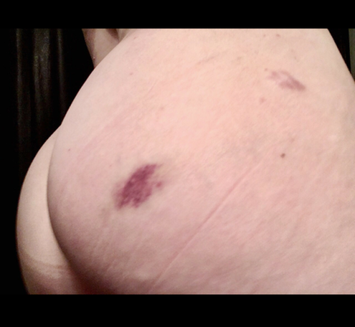 I am looking at the bruises and more&hellip;