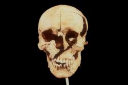 skeleton-sapper-in-the-wire:  museum-of-artifacts:  Skull from Battle of Towton (1461) showing war hammer wound   W A R H A M M E R