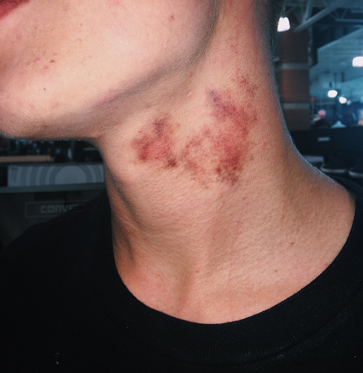 couplexgoals:love bites