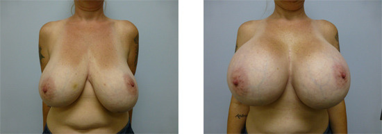 One of the most popular methods of real life breast expansion is simply to get breast