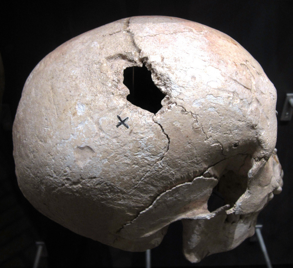 emt-monster:  Healed head injuries from sword blows (meaning they survived the injury)