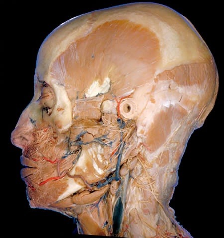 A deep dissection of the side of the head shows the many blood vessels (red arteries,