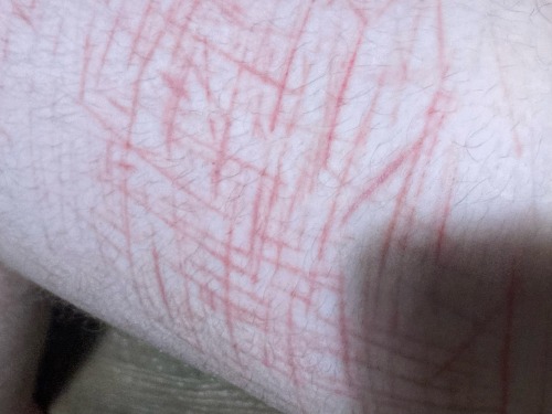 Tw Self H@rm Sc@rs