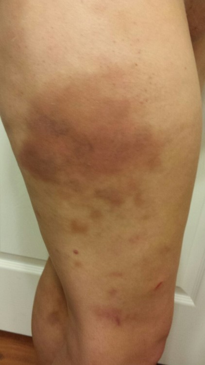 Day 0 of the giant thigh bruise I earned on Saturday and into Sunday. During the scene we had on Sat