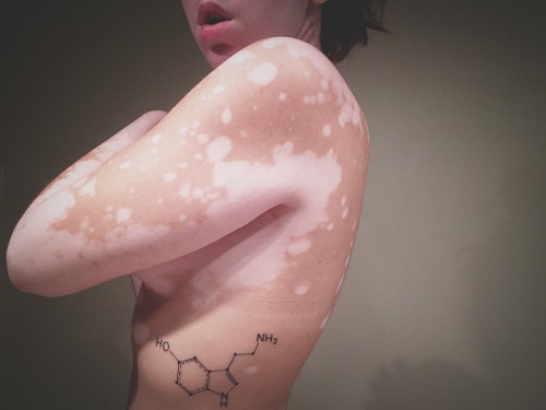 prozac-panda:  alxhrta:  I got happiness on my side; literally.  As someone who also suffers from some sort of skin condition, I find this absolutely beautiful. Ab-so-lutely b-e-a-utiful <3 