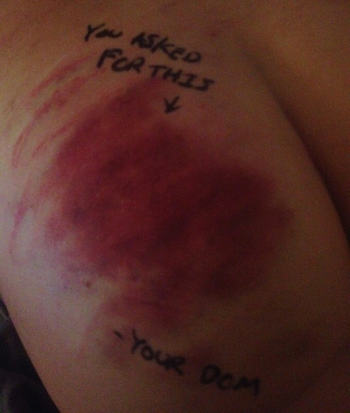 sanctuaryfromself:It’s true.  I literally asked for bruises this severe, and he revels in