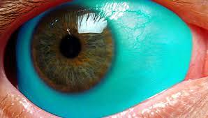 sixpenceee:  Corneal tattooing is when someone gets a tattoo on the cornea of their eye. Generally in most procedures, the dyeing agent is applied directly to the cornea. India ink is the most commonly used, providing safe and long-lasting effects.