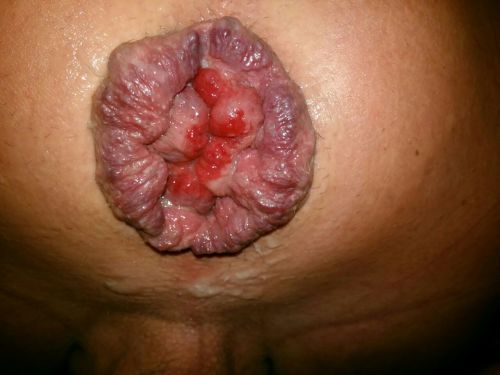 open24: Mancunt - My extreme asshole prolaps