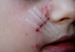 veiled-in-flesh:   Child with butterfly stitches~* 