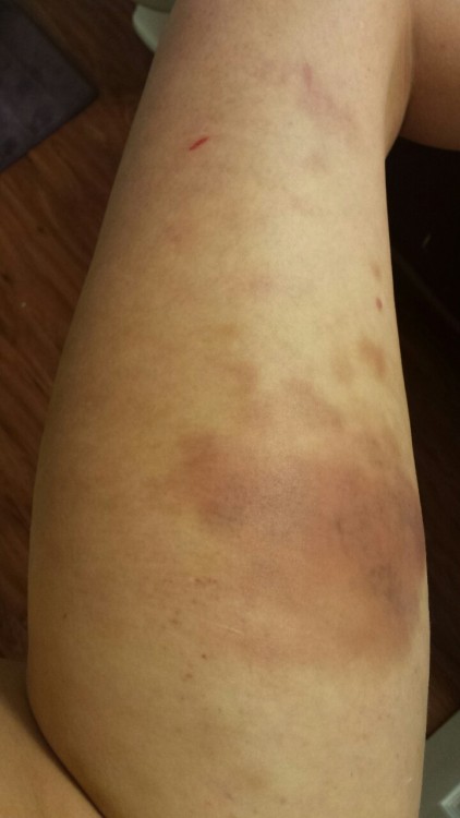 Day 0 of the giant thigh bruise I earned on Saturday and into Sunday. During the scene we had on Sat