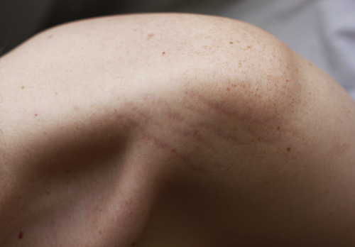 ginocchia:  My boyfriend’s stretch marks, one of the most beautiful things I’ve ever seen.
