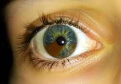 sixpenceee:  In sectoral heterochromia one part of the eye is different from it’s remainder. Heterochromia, in general is the result of excessive pigment. It can be inherited or caused by disease &amp; injury.  