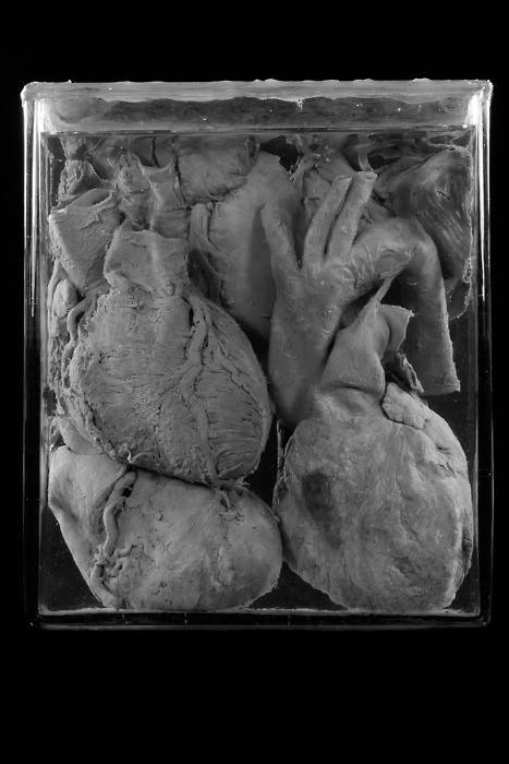 the-human-satan:  the-hidden-dagger:  Five Human Hearts. Ryan Matthew’s Collection. Photo