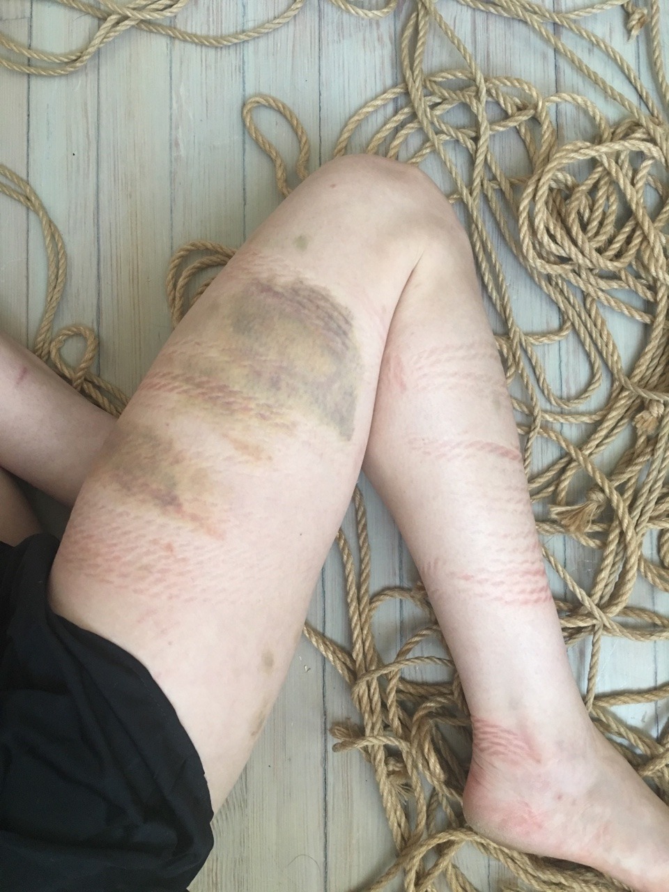 camdamage:Rope marks and bruisies 😊💖