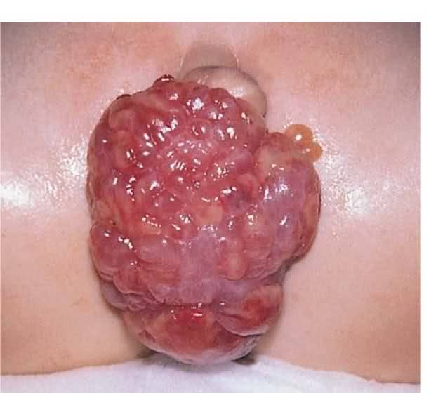 Sarcoma Botryoides or Embryonal rhabdomyosarcoma
• Children < 4yo
• Polypoid, grape-like soft tissue protruding from vagina
• Micro: spindle shaped cells with cross striations, Cambium layer (tumor growths beneath vaginal epithelium)
• Tumor cells...