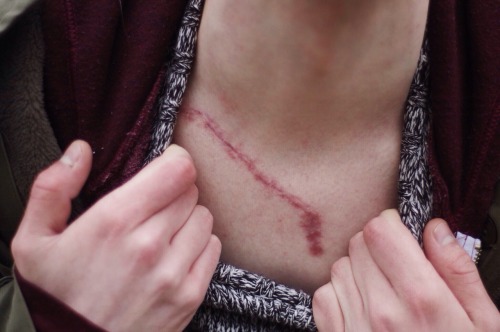 nachttrip:  Ex boyfriend and his beautiful scar