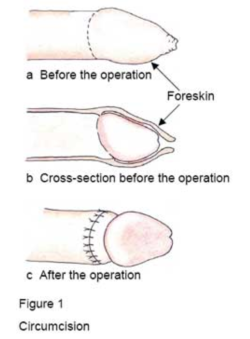 uncut2cut:  marccresset56:    The oldest surgery known to humanity. Even many thousands of years ago our ancestors knew that foreskin is an anatomical mistake and that it was important enough to do even without anaesthesia.  Such an important modification