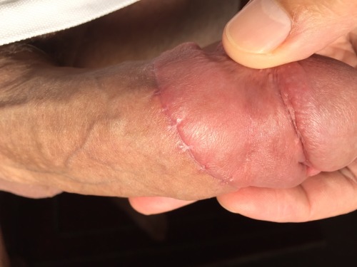 tightlycut: My circumcised penis in the morning sunshine. I love my smooth, dry, exposed glans. It&r
