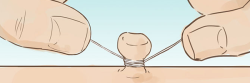 Using String is to Remove a Skin Taghttp://www.cliffys.com.au/removal-guide/how-to-tie-string-around-skin-tags/