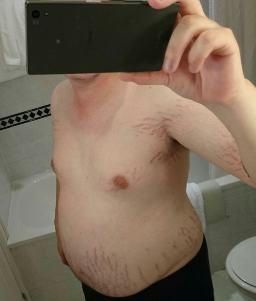 Im Finding Stretch Marks Where No Stretch Mark Has Gone Before