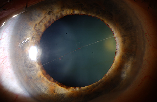 eps-ilon:  cataract 