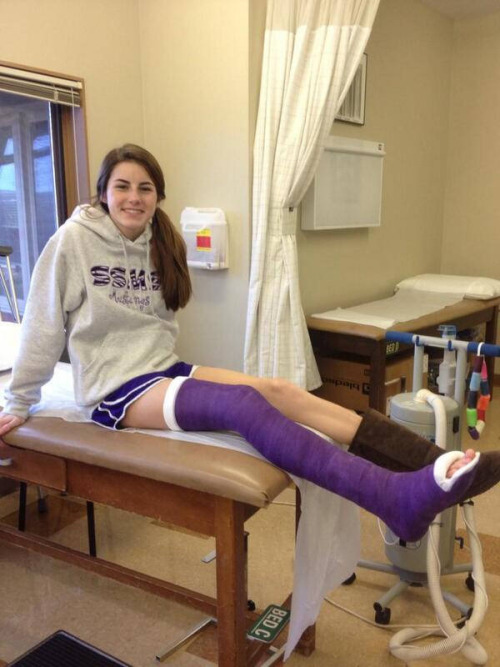 Sporty girl with a nice fresh long leg cast on her broken leg