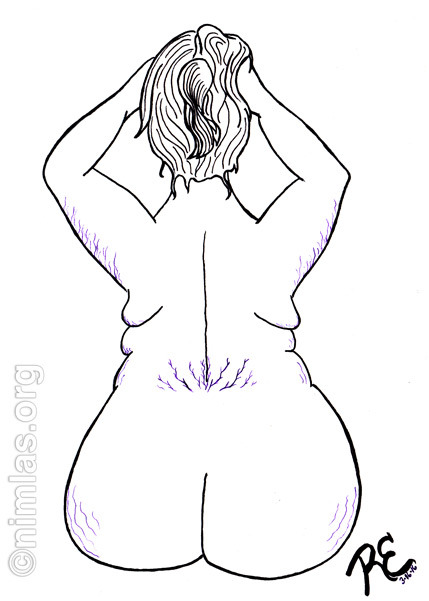 nuchtchas:Daily Creativity: Love Your Stretch MarksDaily Creativity: Love Your Stretch Marks Thanks 