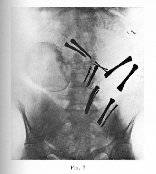 Fluoroscopic images of fetuses in utero, with position of arm and leg bones highlighted, c.1932. Flu