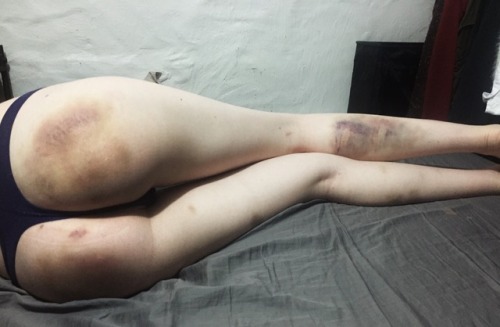 defiantly-yourss:I wonder if one day I’ll just morph into on giant bruise. Seems likely.