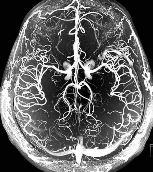 infomedicos: Angiografia. Vasos del cerebro.