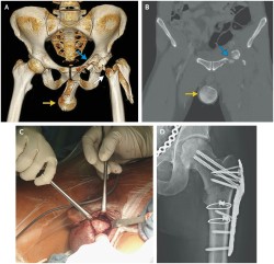 emt-monster:cluelessmedic:Femoral Head Dislocation to Scrotum33 year old male admitted following motorcycle accidenthard swollen bluish scrotum and externally rotated shortened left leg CT showed dislocated left hip, trochanteric left femoral fracture