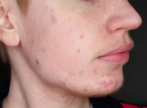 sveriqueer: a little over 10 months on T face acne? not too bad, have had much worse shoulder (&