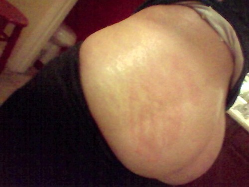 immasexymomma: mrdickandlovesbians slapped my ass hard enough to leave wicked welts all over my ass.