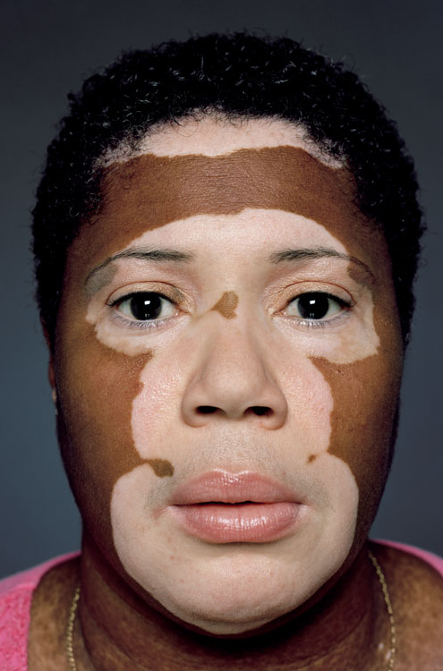 flyandfamousblackgirls:   Vitiligo is a condition in which people lose melanin – the pigment that gives skin its color – resulting in white patches of skin. While the exact cause of vitiligo is unknown, it has been confirmed that an autoimmune component