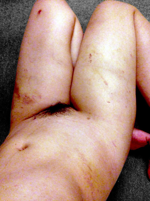 Sex koto-bdsm:  8 days later pictures