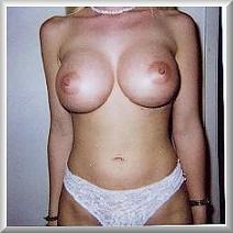 XXX breastsandbraanalysis:  ..before and after photo