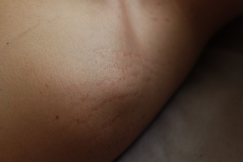 ginocchia:  My boyfriend’s stretch marks, one of the most beautiful things I’ve ever seen.