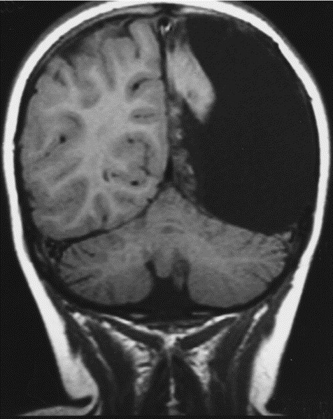 strangebiology:  A three-year-old girl had a hemispherectomy to treat Rasmussen syndrome.